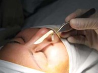 Thiếu nữ 17 hoại tử mũi vì nâng ở spa